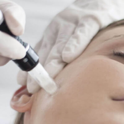 microneedling-targoviste