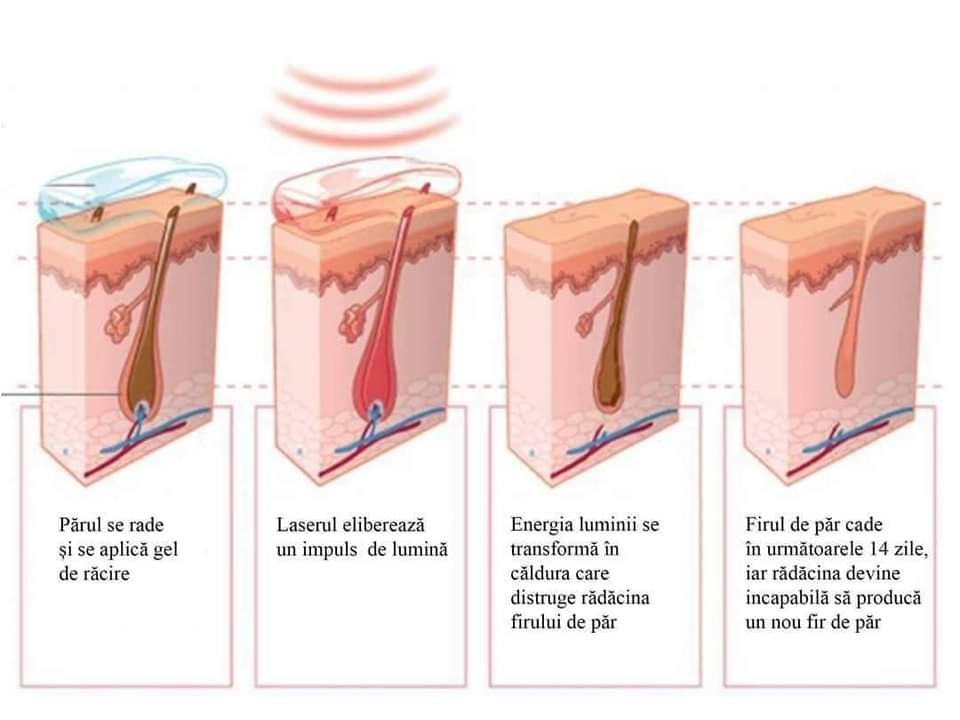 laser-dioda-targoviste